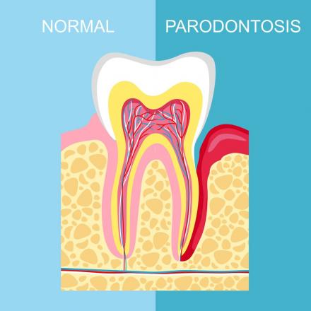 Parodontologie Zahnfleischbluten Zahnfleischentzündung
